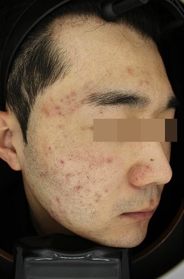 서울대입구역 피부과 여드름치료 후기 5주간의 여정! 관련 이미지 6