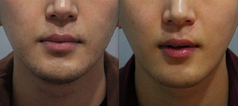 서울대입구역 피부과에서 남자제모 받은 후기 관련 이미지 5