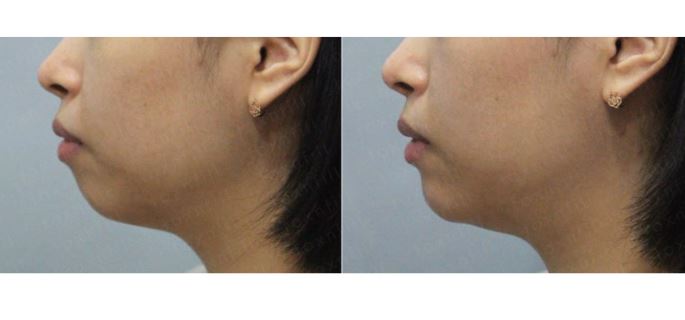 [톡스앤필관악점] 투턱?투턱엔 턱끝필러!! 턱끝필러&자갈턱보톡스 후기!! 관련 이미지 1