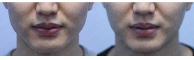 관악구피부과에서 턱보톡스 시술받고 브이라인 만든 후기 관련 이미지 2