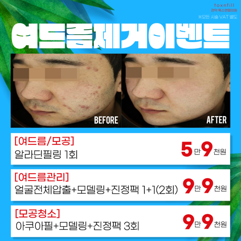 톡스앤필 서울대점 7월31일까지 여름나기 이벤트 돌입! 관련 이미지 2