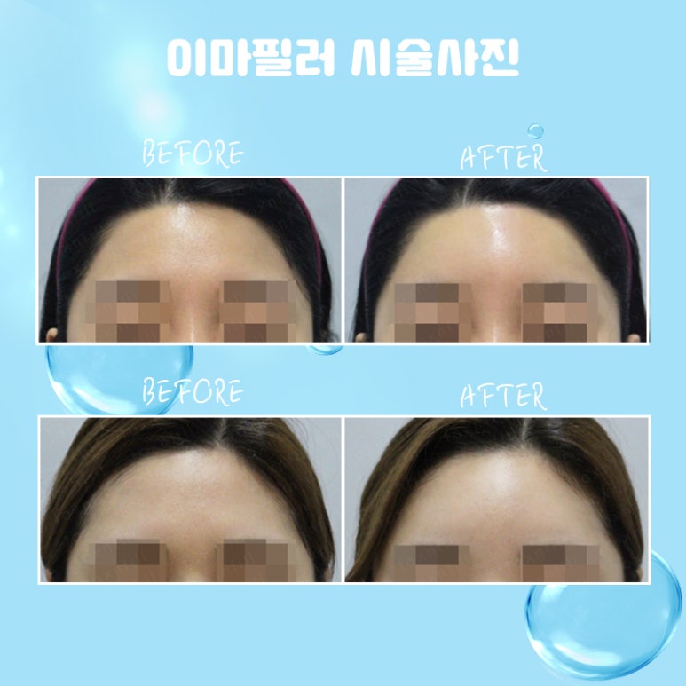 관악구 자연스러운 이마필러 관련 이미지 4
