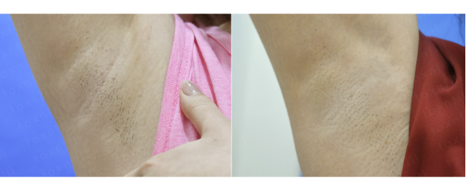 [톡스앤필관악점] 겨드랑이제모? 어디서? 여기서!!겨드랑이제모후기 관련 이미지 1