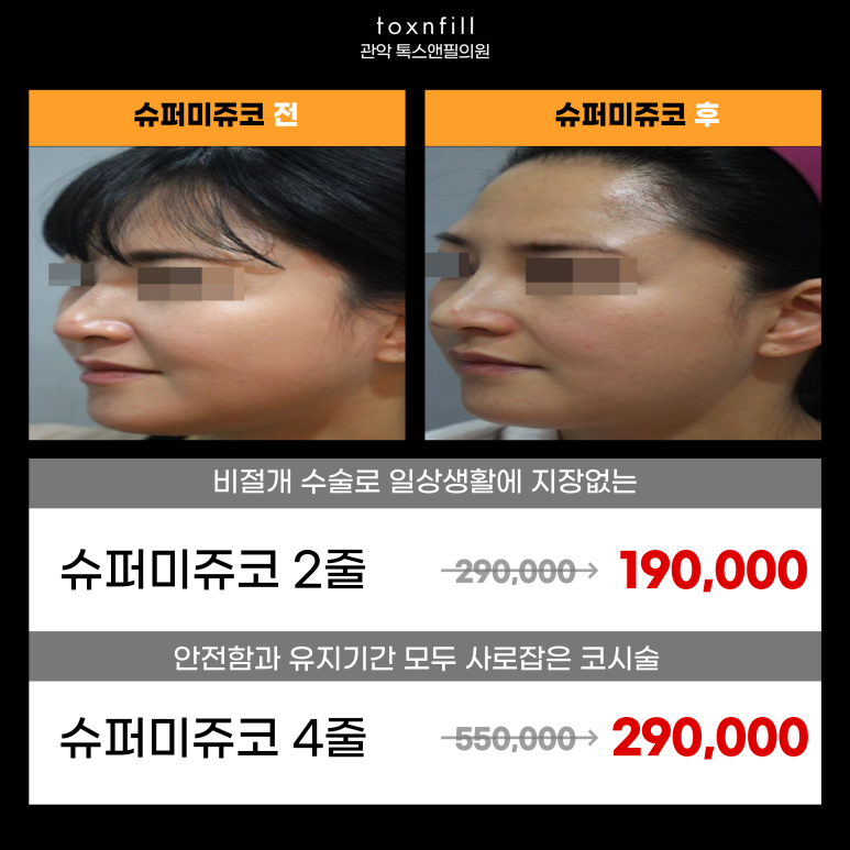 관악구피부과에서 매부리코 코필러가아닌 실로 콧대높히기 관련 이미지 4