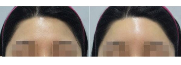 [톡스앤필관악점] 푹꺼진 이마에 자신감을 채워넣다!! 이마필러 후기!! 관련 이미지 2