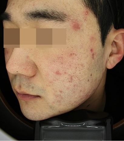 관악구피부과에서 여드름치료 5주간 리얼 후기!(내돈내산) 관련 이미지 4