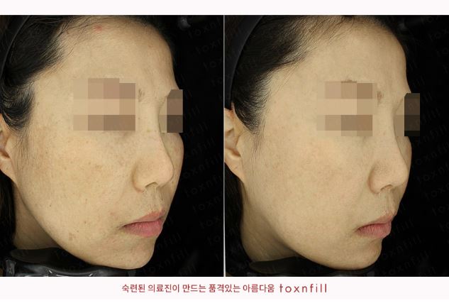 서울대입구역피부과 기미,주근깨에 합리적인 피부관리에 대해서 설명 및 후기와 가격정보 관련 이미지 1