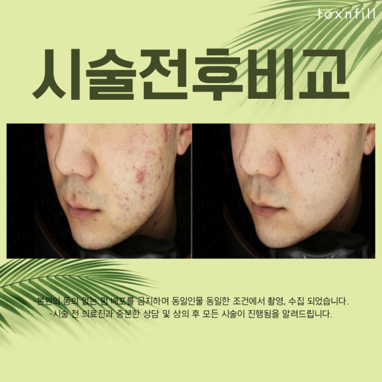[ToxnFill Seoul National University Branch] Newly Launched Acne 8-Week Package Open! image 4