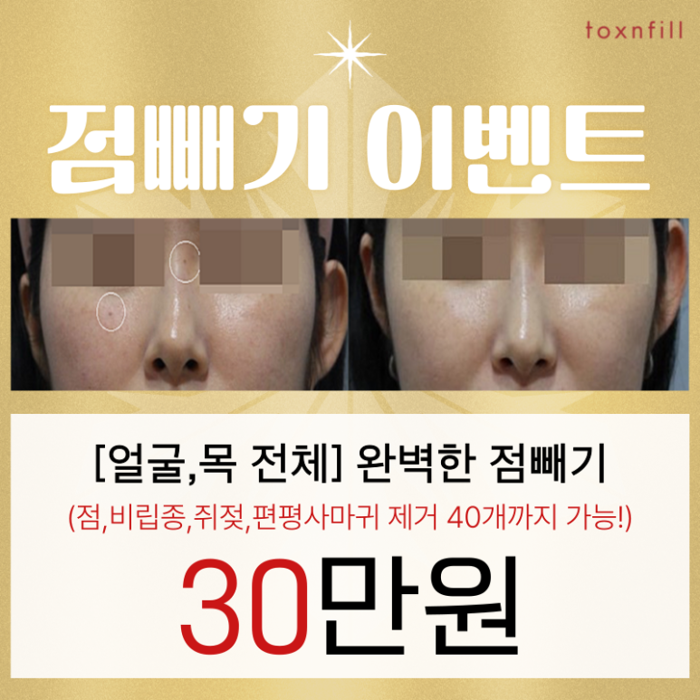 [톡스앤필서울대점] 40개까지 가능한 점빼기 이벤트! 관련 이미지 1