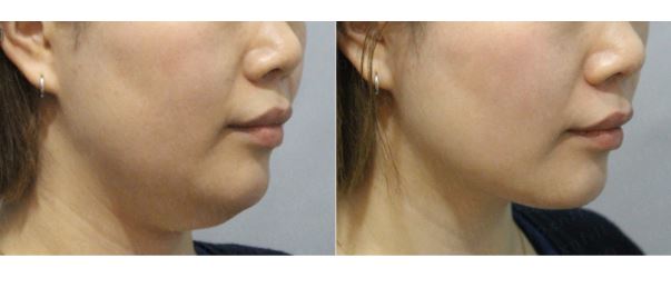 관악구피부과 에서 추천하는 연예인주사 및 윤곽주사 관한 생생한 정보와 후기!!! 관련 이미지 1