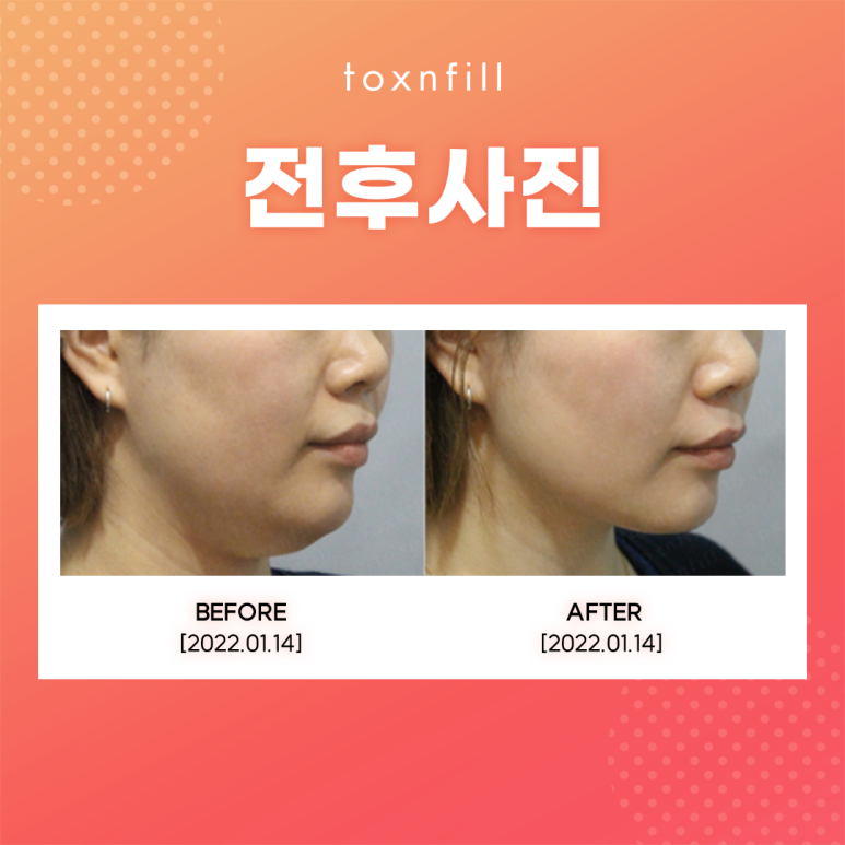 스테로이드 없는 관악구피부과의 연예인주사 관련 이미지 5