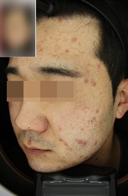 서울대입구역 피부과 여드름 5주 프로그램 관련 이미지 3