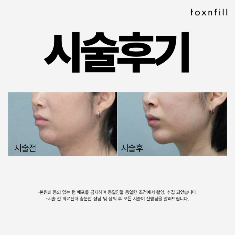 [톡스앤필서울대점] 인모드FX 할인 혜택보고가세요~! 관련 이미지 4