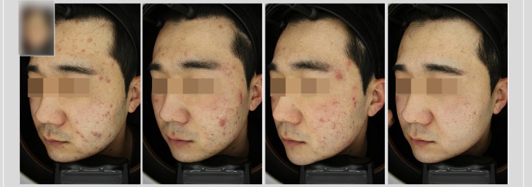 관악구피부과에서 화농성여드름치료한 후기!(여드름이 자주생기는분들,많은분들 보시면 도움이 될) 관련 이미지 2