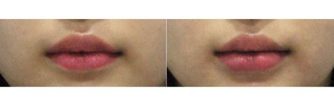 관악구피부과 시술맛집 입술필러 제대로 알고 시술받자! 관련 이미지 1