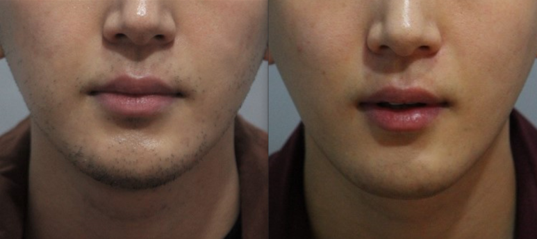 서울대입구역피부과에서 남자수염제모 할인혜택받음 관련 이미지 5