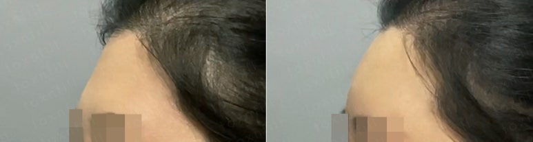 서울대입구역피부과 이마필러 100프로 만족후기 관련 이미지 3