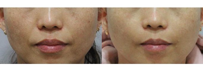 [톡스앤필관악점]  서울대입구역 팔자주름필러 잘하는곳! 가격착한곳! 팔자주름필러후기 관련 이미지 1