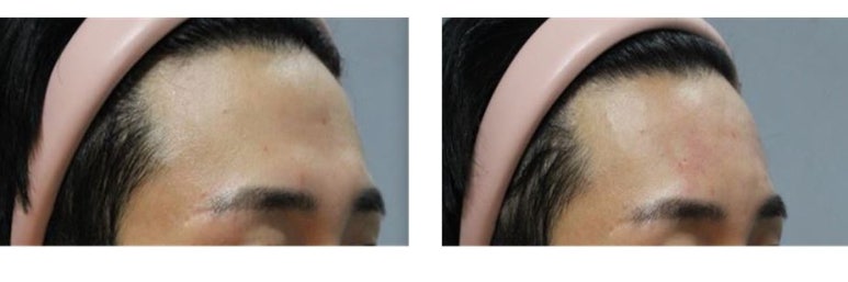 [톡스앤필관악점] 관악구피부과 남자이마필러잘하는곳! 이마필러후기!! 관련 이미지 1