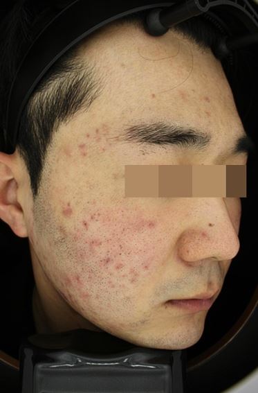 서울대입구역 피부과 여드름치료 후기 5주간의 여정! 관련 이미지 7