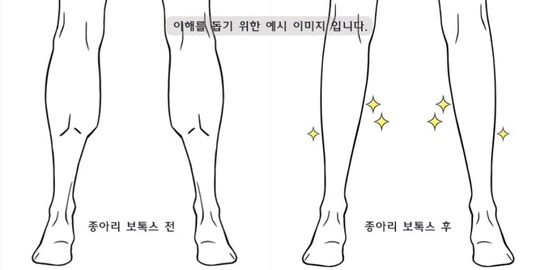 관악구피부과 바디보톡스로 매끈한 바디라인 만들기! 관련 이미지 5