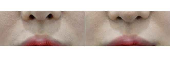 [톡스앤필관악점] 겨드랑이 제모 &인중 제모 레이저로 깔끔하게!! 관련 이미지 2