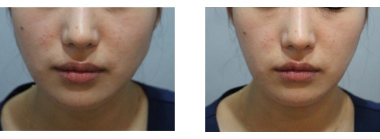 서울대입구역피부과에서 턱보톡스 받은 후기 가격정보와 할인혜택 (내돈내산) 관련 이미지 1