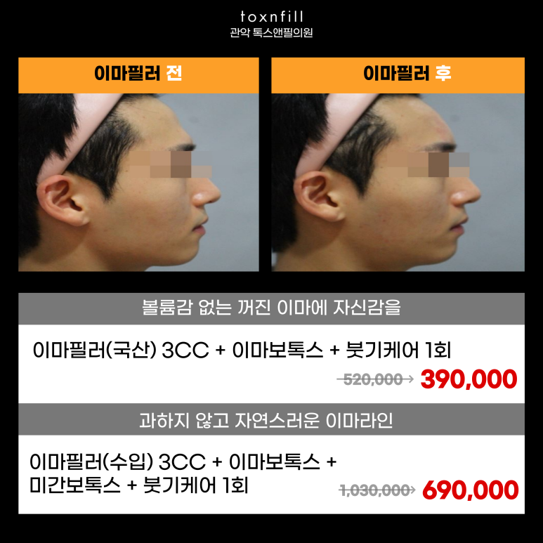 서울대입구역 피부과에서 이마필러로 볼륨감 채웠어!!#자연스럽다 관련 이미지 4