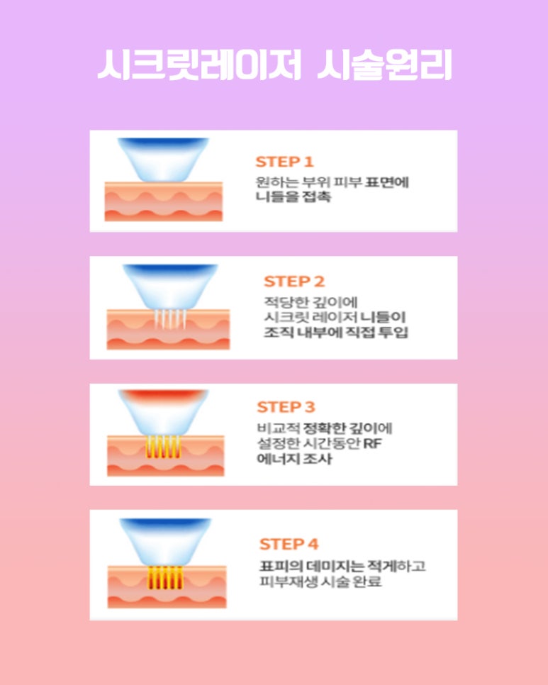 시크릿레이저? 톡스앤필에서 알아보기 관련 이미지 6