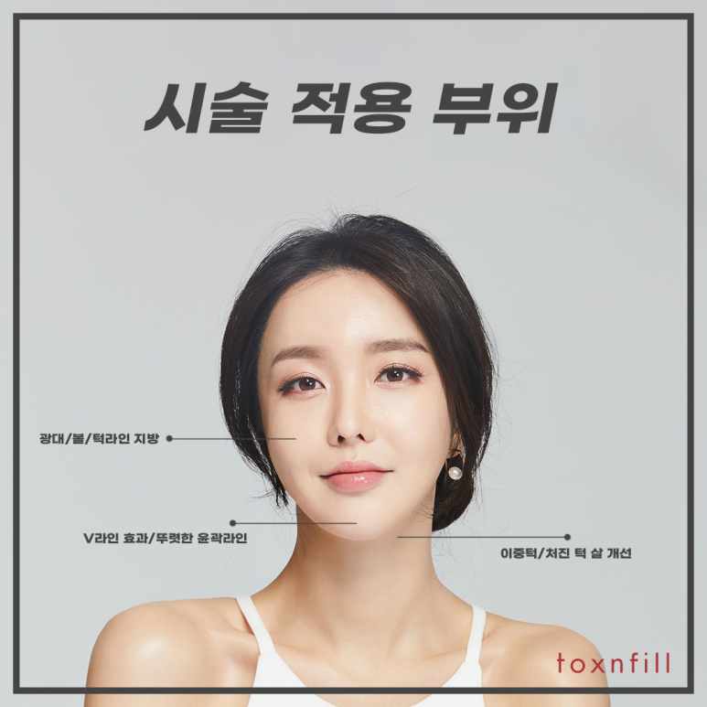 톡스앤필 이중턱 조각주사 관련 이미지 3