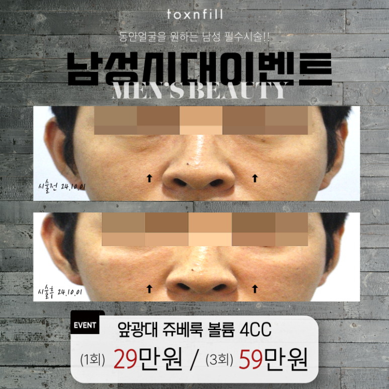 [남성시대] 연애하고싶은 남자들의 동안얼굴 필수 시술!! 관련 이미지 1