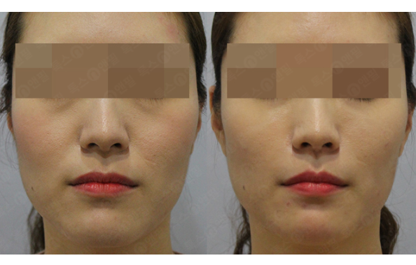 [톡스앤필관악점]깊은 팔자주름 해결? 이젠 걱정말고 톡스앤필서울대입구에서!!! 관련 이미지 1