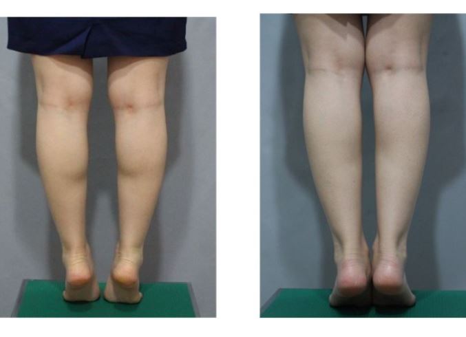 서울대입구피부과에서 종아리 보톡스 맞은 후기와 정보! 관련 이미지 1