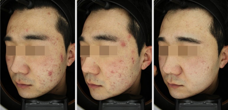 서울대입구역피부과 #여드름 완벽제거 #PDT #애플레이저효과 관련 이미지 2
