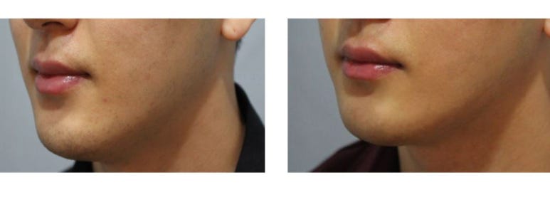 남자얼굴의 완성은 제모다! 관악구피부과에서 남자제모에 관한 정보과 제모후기까지 다 알려드림! 관련 이미지 1