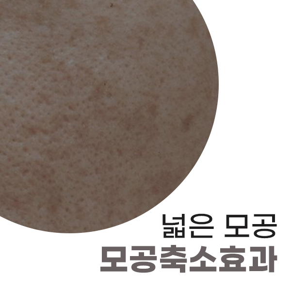 서울대입구역 여드름케어 애플레이저 애플토닝, 원인부터 해결하세요 관련 이미지 5