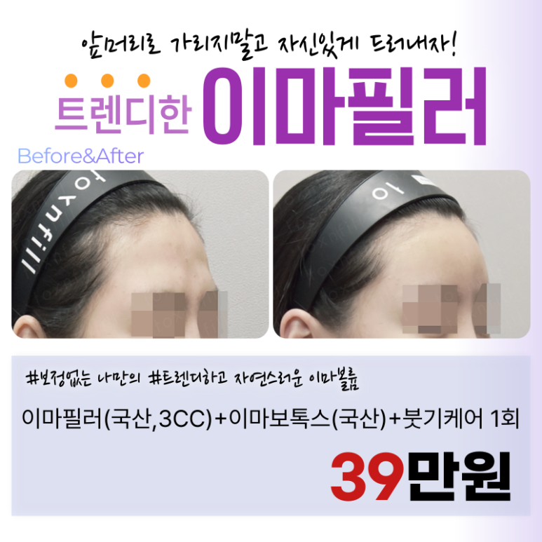 [Toxnfill Seoul National University Branch] Trendy and Natural Forehead Volume image 1