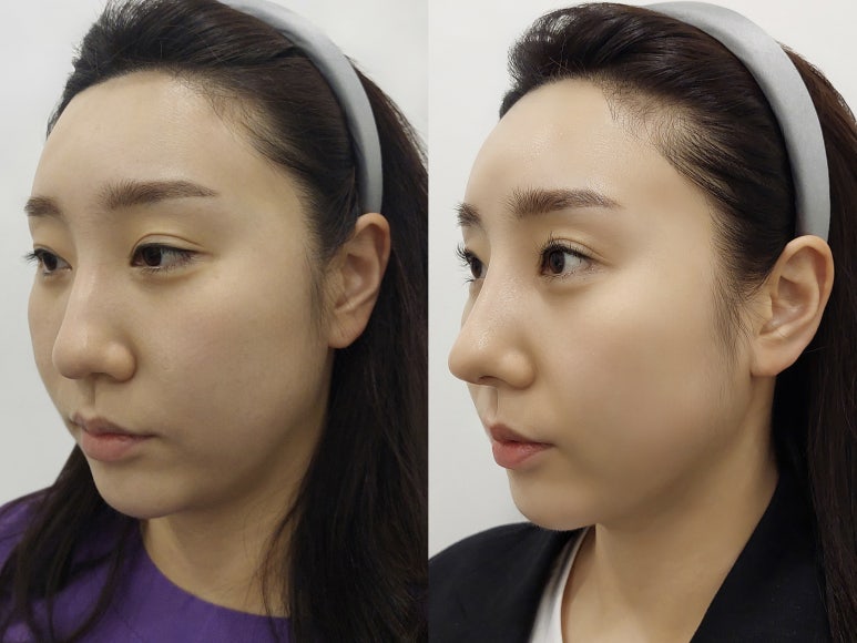 코성형 자연스러운 아름다움 맞춤설계 중요성 관련 이미지 3