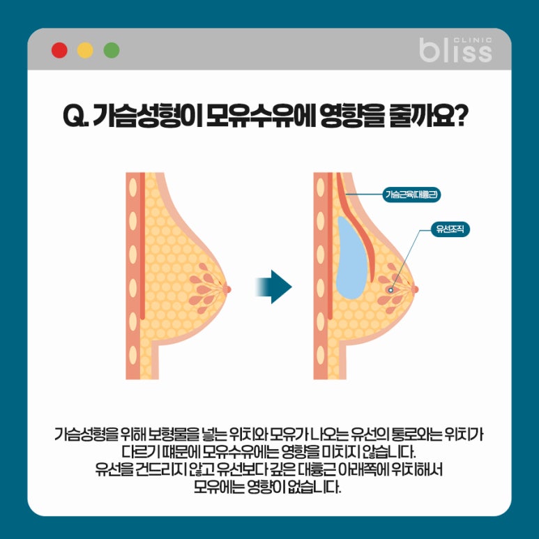 가슴성형 모유수유 가능한가요? 관련 이미지 2