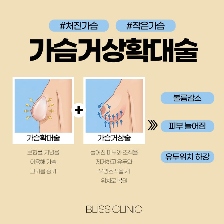 유륜절개법, 가슴확대와 거상 동시에 가능?! 관련 이미지 2