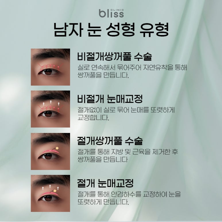 남자 눈성형, 긍정적인 인상으로 변화는 핵심 포인트 관련 이미지 4