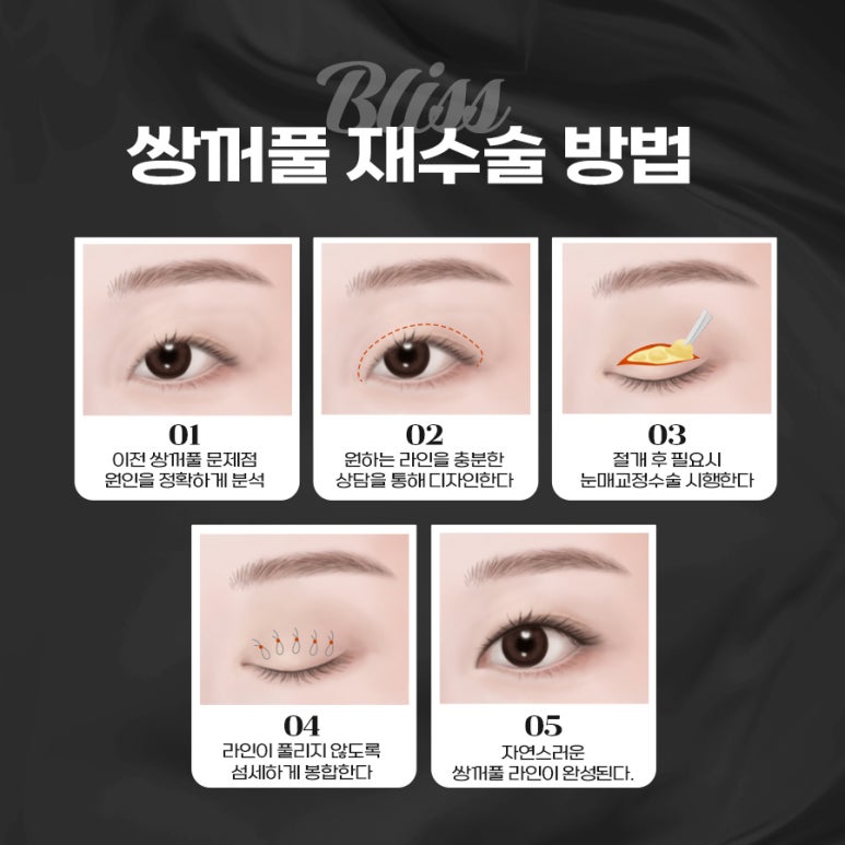 눈재수술, 시기부터 회복까지 제대로 준비하는 법 관련 이미지 3