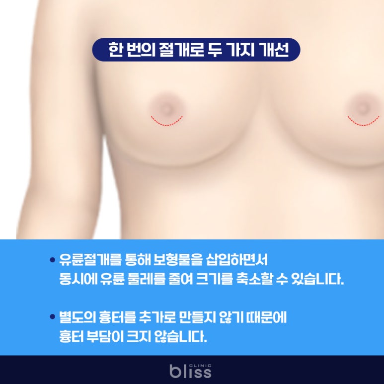유륜절개 가슴성형 Q&A, 꼭 알아두세요 관련 이미지 6