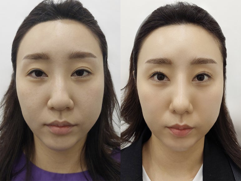 코성형 자연스러운 아름다움 맞춤설계 중요성 관련 이미지 6