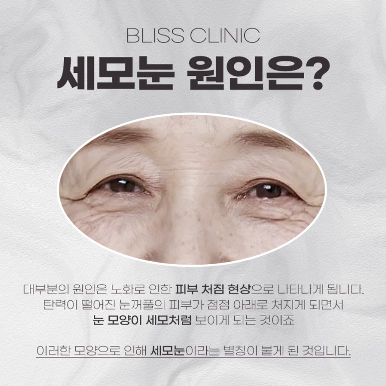 사나운 눈매로 보이는 세모눈 원인과 교정 방법 관련 이미지 2