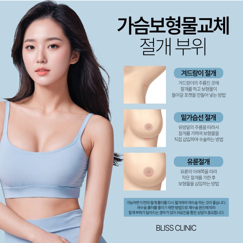 가슴확대수술 보형물 교체 시기 10년마다? 보형물 종류 방법 추천 관련 이미지 6
