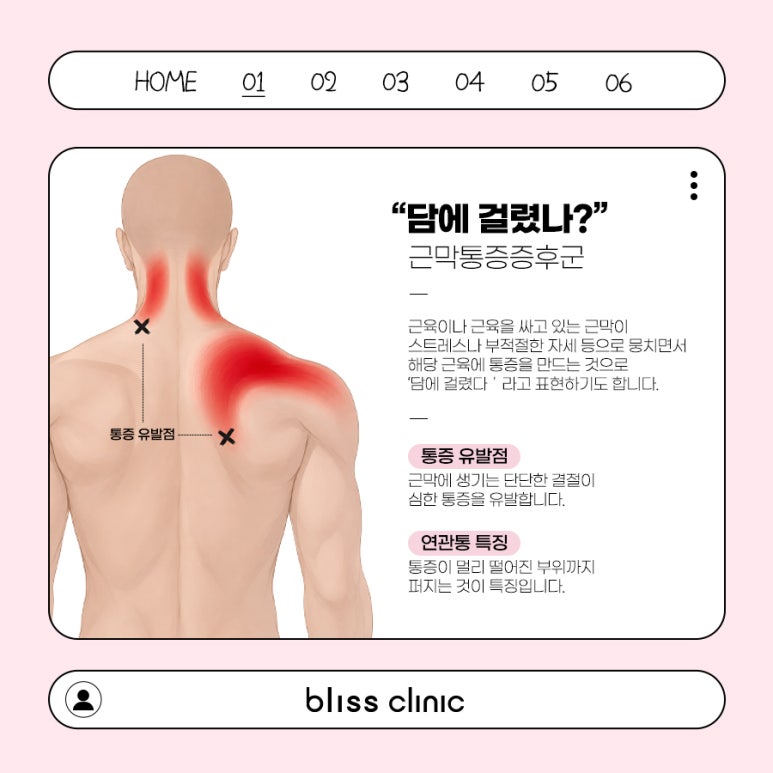 목어깨 담걸림, 스톨즈 체외충격파 효과 있을까? 관련 이미지 2