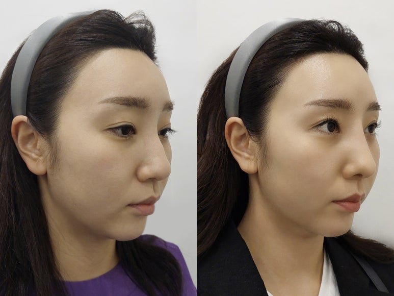 블리스의원 수능이벤트, 수험생을 위한 특별한 응원 선물 최대 30% 할인 관련 이미지 4