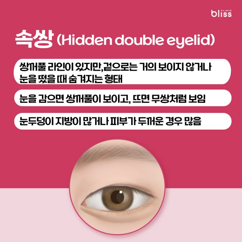 대표적인 쌍꺼풀 라인 5가지, 내 눈에 맞는 스타일은? 관련 이미지 6