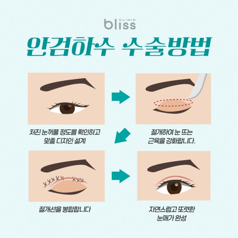 안검하수교정 성공을 위해 고려해야 하는 부분은 관련 이미지 4